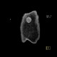 Lipofibroma, subcutaneous: CT - Computed tomography